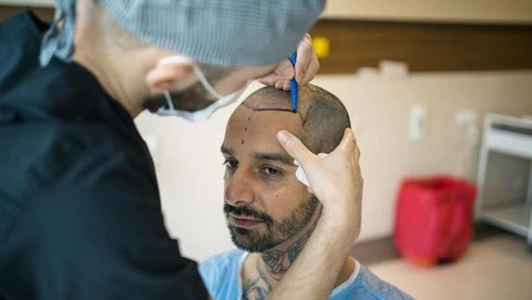 Hair transplant Sultanatexplore